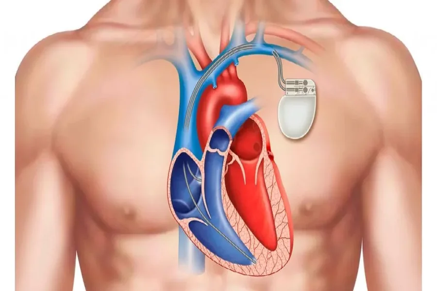 Pacemaker Cost